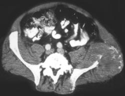 Lymphoma - CTisus CT Scan