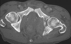 Lymphoma - CTisus CT Scan