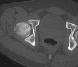 Osteoid Osteoma - CTisus CT Scan