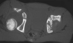 Hip Fracture / Dislocation - CTisus CT Scan