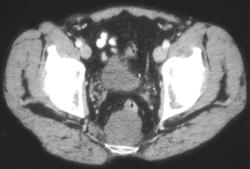 Chordoma - CTisus CT Scan