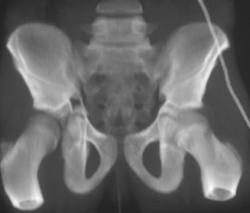 Hip Fracture With Superior Acetabular Injury - CTisus CT Scan