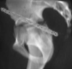 Repair of Hip Fracture / Dislocation - CTisus CT Scan