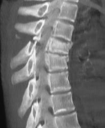 T-spine Fracture - CTisus CT Scan