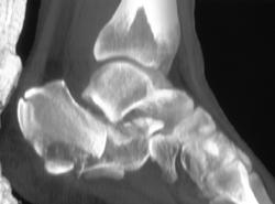 Comminuted Calcaneal Fracture - CTisus CT Scan