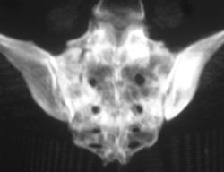 Stress Fracture - CTisus CT Scan