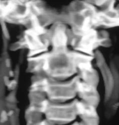 Normal Odontoid - CTisus CT Scan