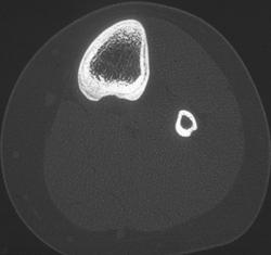 Periosteal Reaction - CTisus CT Scan