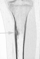 Stress Fracture - CTisus CT Scan