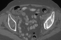 Healing Stress Fracture - CTisus CT Scan