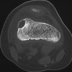 Fracture Through Bone Cyst - CTisus CT Scan