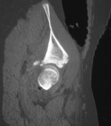 Fracture Posterior Lip Left Acetabulum - CTisus CT Scan