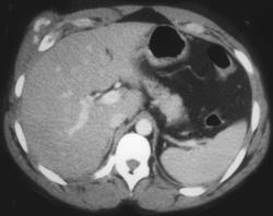 Active Bleed Anterior Right Abdominal Wall S/P Stab Wound - CTisus CT Scan