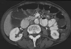 Muscle Metastases - CTisus CT Scan