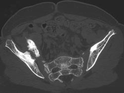 Nonunion Acetabular Fracture - CTisus CT Scan