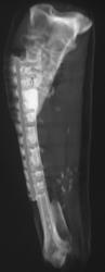 Post Grafting of Radius and Ulna - CTisus CT Scan