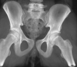 Pinning of Femur Fracture - CTisus CT Scan