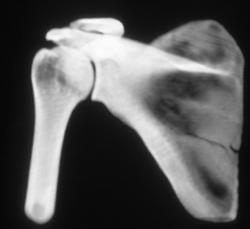 Scapular Fracture - CTisus CT Scan