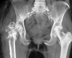 Fracture Through Area of Prior Hip Pinning - CTisus CT Scan