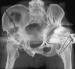 Iliac Wing Fracture in Patient With Total Hip - CTisus CT Scan