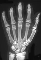 Normal Wrist - CTisus CT Scan