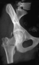 Post Repair of Hip Fracture / Dislocation - CTisus CT Scan