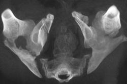 Nonunion Acetabulum - CTisus CT Scan