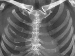 Post Median Sternotomy - CTisus CT Scan