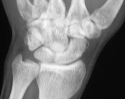 Scaphoid Fracture - CTisus CT Scan