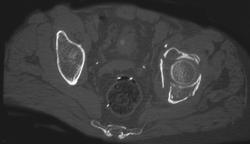 Acetabular Fracture - CTisus CT Scan