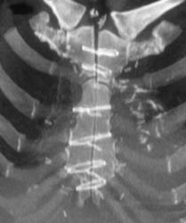 Sternal Nonunion - CTisus CT Scan