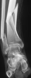 Spiral Fracture of Tibia and Fibula - CTisus CT Scan