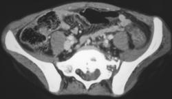 Lymphoma Sacrum - CTisus CT Scan