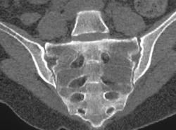 Metastatic cancer of the sacrum - rogather.ro