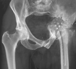 Failed Total Hip Replacement - CTisus CT Scan