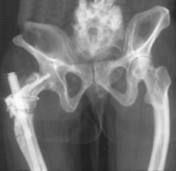 Osteogenesis Imperfecta - CTisus CT Scan