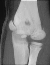 Chip Fracture - CTisus CT Scan