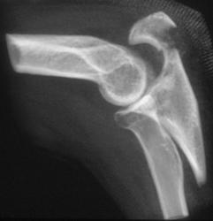 Olecranon Fracture - CTisus CT Scan