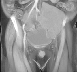 Chordoma - CTisus CT Scan