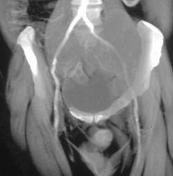 Chordoma - CTisus CT Scan