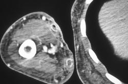 Infecting Graft With Air - CTisus CT Scan