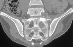 Ewing Sarcoma - CTisus CT Scan