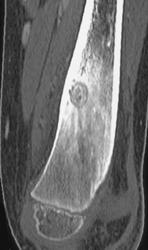 Osteoblastoma - CTisus CT Scan