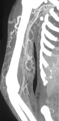 Infected Graft With Collaterals - CTisus CT Scan