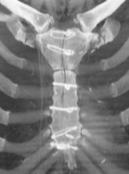 Nonunion of Medial Sternotomy - CTisus CT Scan