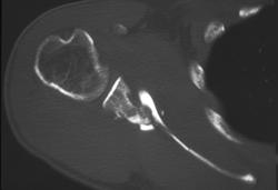 Scapular Fracture - CTisus CT Scan