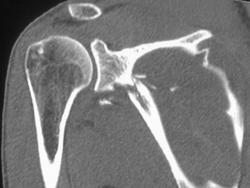 Scapular Fracture - CTisus CT Scan