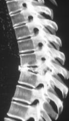 Metastatic T-spine Lesion - CTisus CT Scan