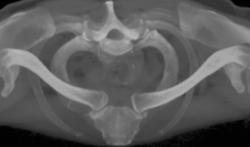 Normal S/c Joints - CTisus CT Scan