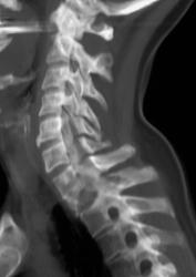 Fusion C-spine - CTisus CT Scan